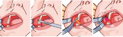 去除頰脂墊手術(shù)過(guò)程示意圖 去除頰脂墊手術(shù)過(guò)程示意圖