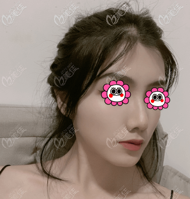 找北京王軍做硅膠假體鼻綜合到現(xiàn)在沒(méi)啥后遺癥,說(shuō)他做鼻子牛有原因