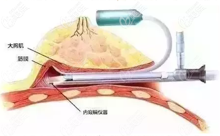 內(nèi)窺鏡雙平面隆胸