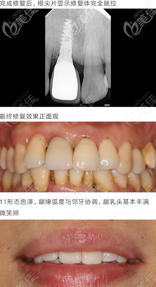 以色列ABT種植牙案例