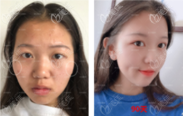 <!--<i data=20240703-sp></i>-->醫(yī)生顴骨手術(shù)案例 <!--<i data=20240703-sp></i>-->醫(yī)生顴骨手術(shù)案例