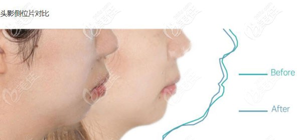 來評價:成都馬瀧齒科用隱適美牙套治療骨性下巴后縮的效果好嗎？