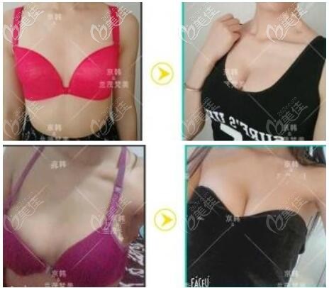 北京京韓脂肪豐胸真實(shí)實(shí)例療效對比圖