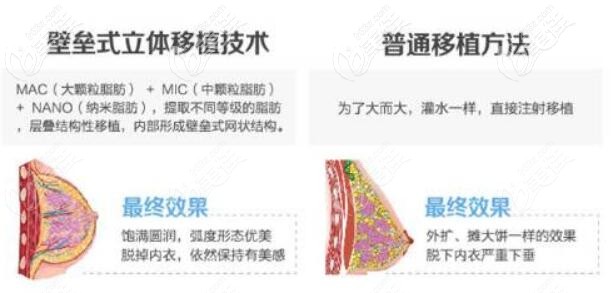 北京京韓脂肪移植豐胸原理