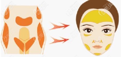 面部脂肪填充的部位 面部脂肪填充的部位
