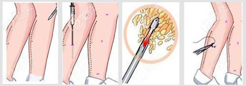 吸脂部位的傷口部位 吸脂部位的傷口部位