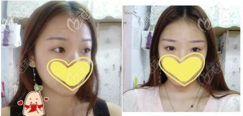 點(diǎn)陣激光去凹疤三次的真實(shí)案例前后效果對(duì)比