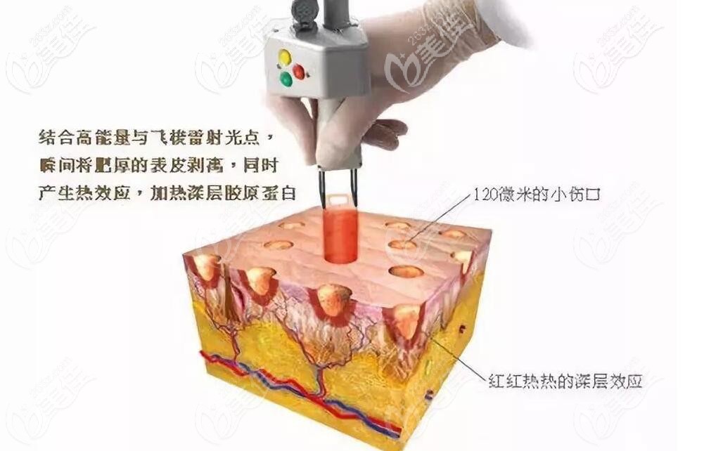 點(diǎn)陣激光去除的好處