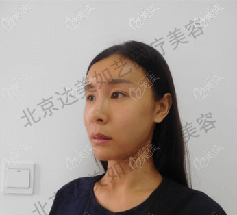 在北京達美如藝做全臉脂肪填充前 在北京達美如藝做全臉脂肪填充前