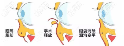 眶隔脂肪釋放手術(shù)過程示意圖 眶隔脂肪釋放手術(shù)過程示意圖