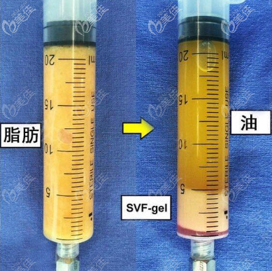 下面那一小部分為SVF-gel脂肪膠