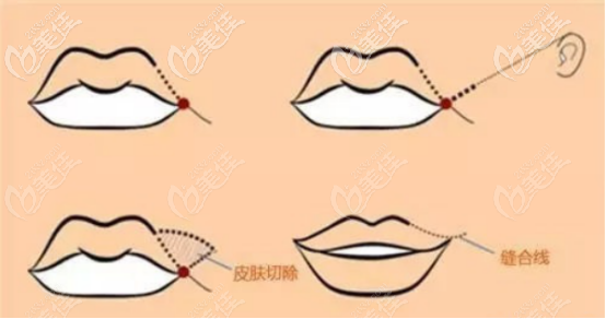 微笑唇的內(nèi)外切口