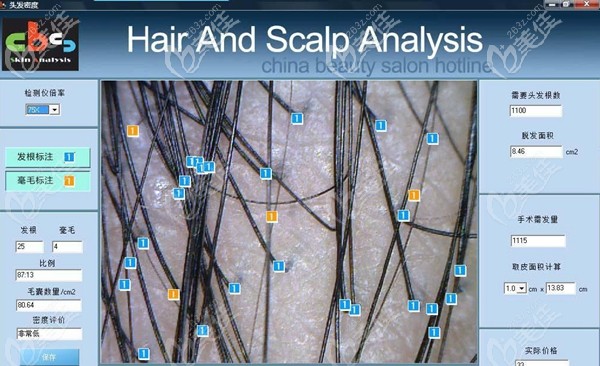 毛囊檢測技術 毛囊檢測技術