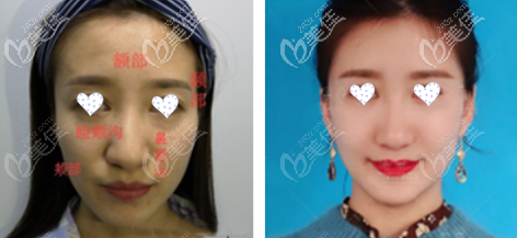 脂肪膠全臉脂肪填充效果圖