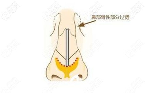 寬鼻的判斷方法 寬鼻的判斷方法