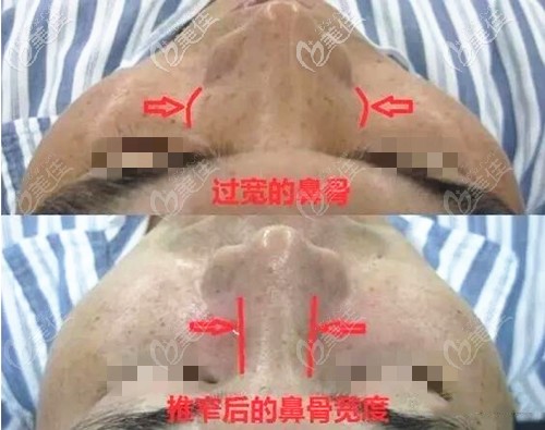 鼻骨內(nèi)推前后對比照 鼻骨內(nèi)推前后對比照