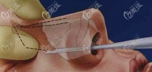 鼻骨內(nèi)推內(nèi)切缺點(diǎn) 鼻骨內(nèi)推內(nèi)切缺點(diǎn)