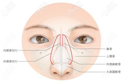 鼻骨內(nèi)推的手術(shù)原理 鼻骨內(nèi)推的手術(shù)原理