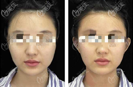 貼發(fā)耳矯正效果圖