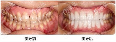 沈陽百嘉麗口腔韓國水晶貼面真人對比照 沈陽百嘉麗口腔韓國水晶貼面真人對比照