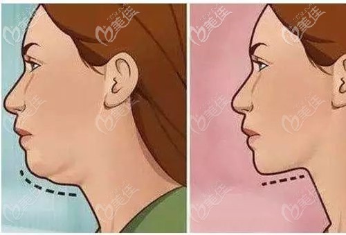 下頜緣松弛怎么提升緊致