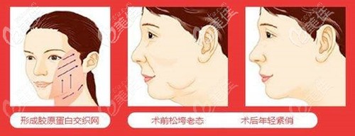 埋線提升下頜緣效果