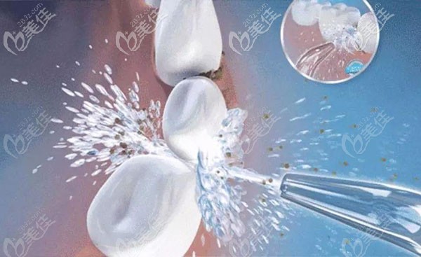 洗牙價格不同的原因