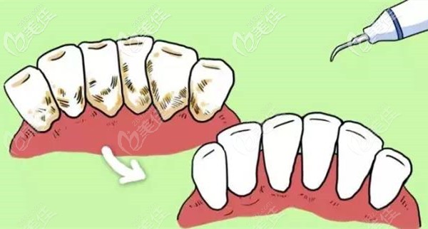 洗牙前后效果圖