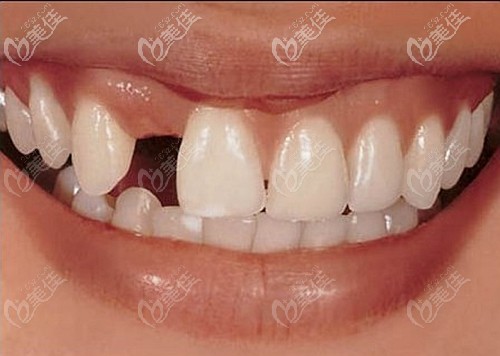 缺失一顆牙應(yīng)該怎么辦