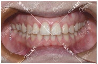 深覆合牙齒矯正前后牙齒效果對比 深覆合牙齒矯正前后牙齒效果對比