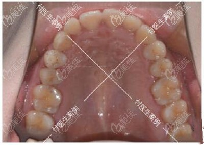 深覆合,露齦笑戴3M金屬自鎖托槽矯正后,都說我像去做了墊下巴
