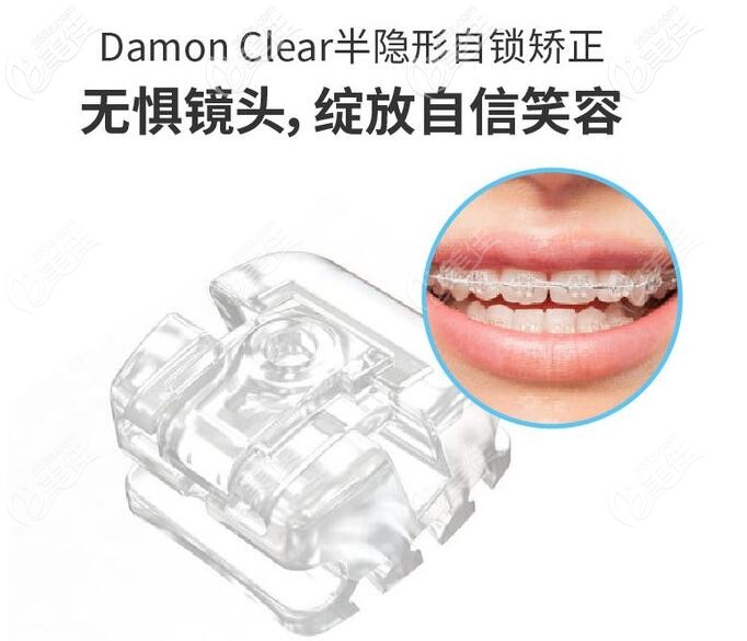 半隱形托槽矯正托槽示意圖 半隱形托槽矯正托槽示意圖