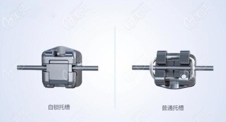 自鎖托槽和普通托槽的區(qū)別 自鎖托槽和普通托槽的區(qū)別