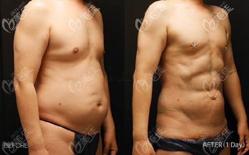 韓國(guó)麗迪安5D腰腹吸脂真人照片