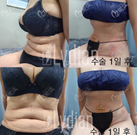 安敬天5D脂肪雕刻術(shù)實(shí)例圖