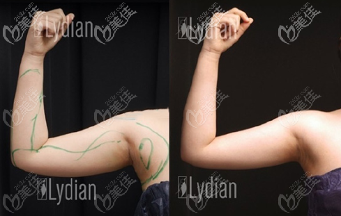 韓國(guó)麗迪安手臂吸脂實(shí)例圖