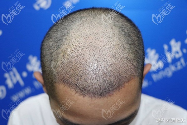 大面積頭頂加密需要多少單位?我是植發(fā)了三千毛囊并有一個(gè)月效果圖為證