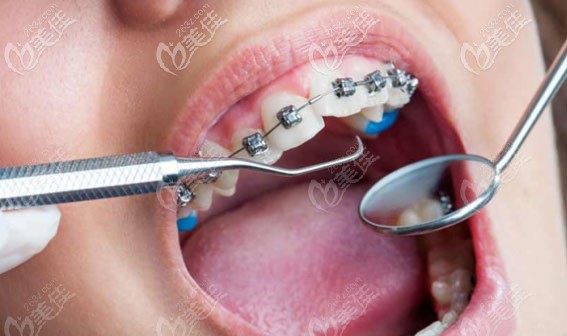 兒童矯正牙齒的較佳年齡