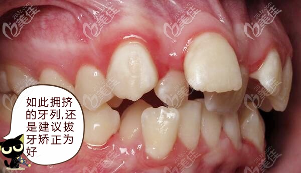 重度擁擠的牙列還是拔牙矯正有效