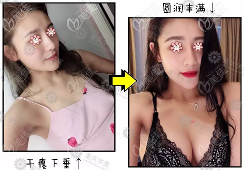 重慶華美傲諾拉320cc假體豐胸效果圖