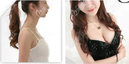 重慶時(shí)光曼托假體隆胸效果圖