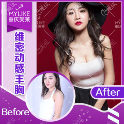 重慶美萊蓓拉假體豐胸效果圖