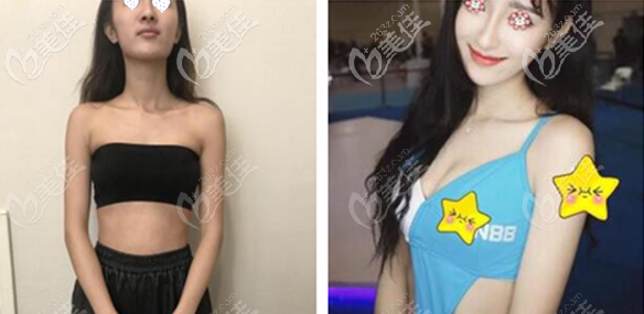 重慶藝星傲諾拉星耀300cc假體隆胸案例