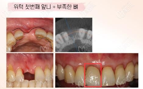 曬出韓國(guó)Goodlife牙科種植一顆前門牙的過程和效果圖