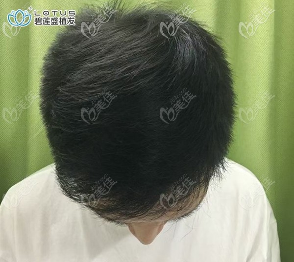 頭頂稀疏加密一年后效果圖