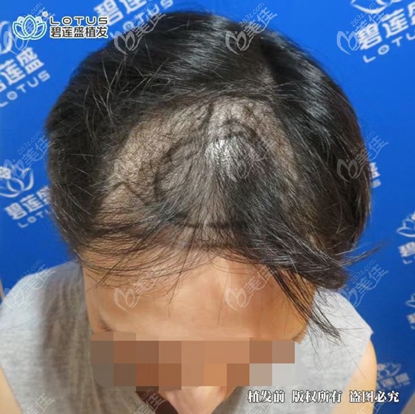 發(fā)友植發(fā)前設(shè)計(jì)效果圖