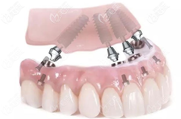 青島馬瀧門診的招牌技術(shù)為半全口種植牙