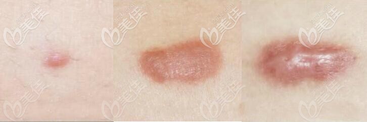 胸前疤痕疙瘩越長(zhǎng)越大圖片