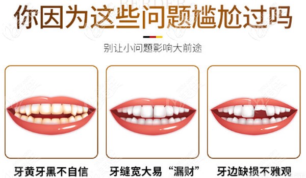 牙齒有這些問題要考慮瓷貼面 牙齒有這些問題要考慮瓷貼面