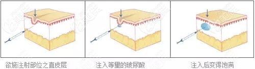 雷醫(yī)生做玻尿酸除皺的原理 雷醫(yī)生做玻尿酸除皺的原理